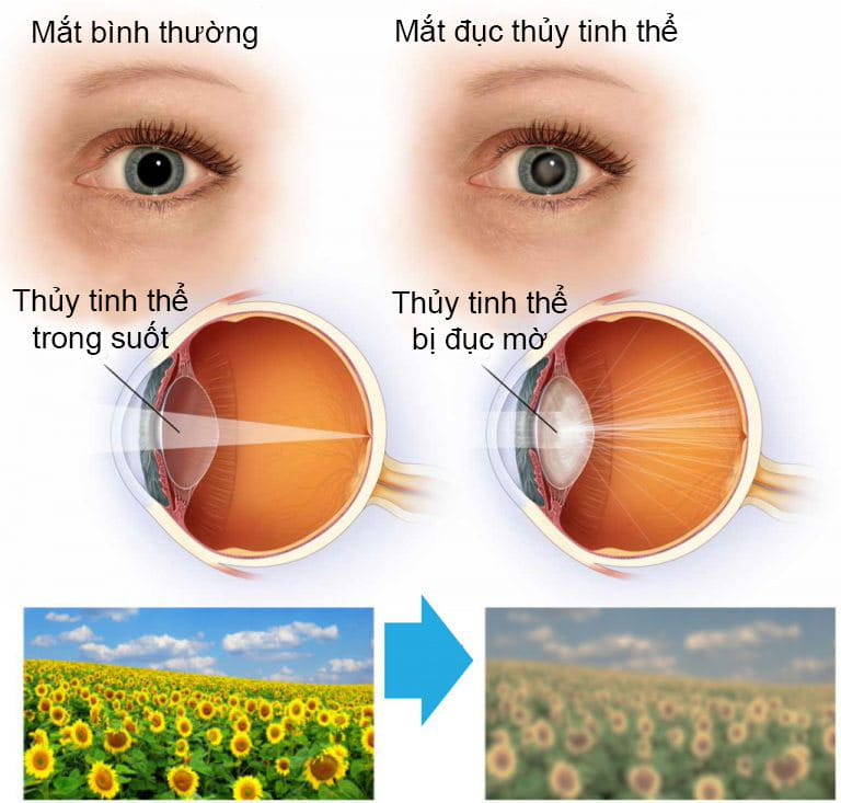 Triệu chứng của Đục thuỷ tinh thể