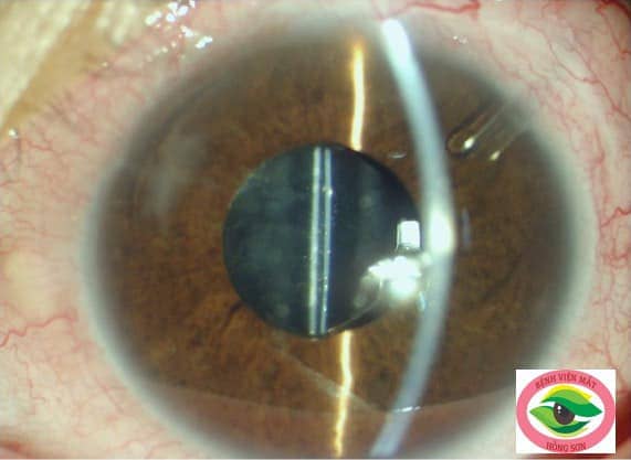 Kết quả sau đặt van Ahmed Glaucoma tại Bệnh viện Mắt Hồng Sơn