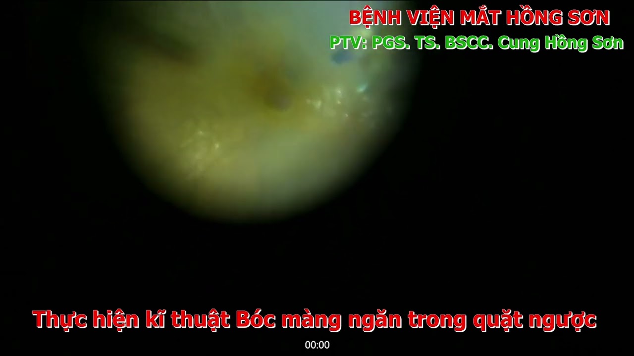 Bóc màng ngăn trong quặt ngược điều trị lỗ hoàng điểm (Inverted Internal Limiting Membrane Flap Technique for Large Macular Holes)