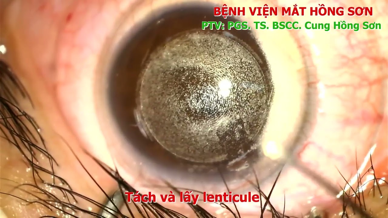 Phẫu thuật điều trị cận loạn thị bằng phương pháp mới CLEAR (Cornea Lenticule Extraction for Advanced Refractive-Correction) CLEAR: The New Version of Smile