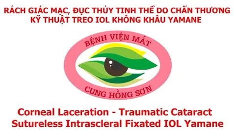 Rách giác mạc, đục thủy tinh thể do chấn thương - Kĩ thuật treo IOL không khâu YAMANE